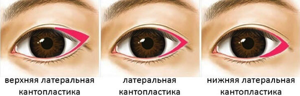 Фото-иллюстрация, как выполняется процедура