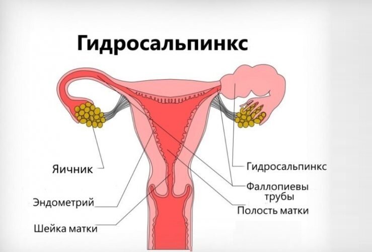 Жидкость в трубе матки причины симптомы