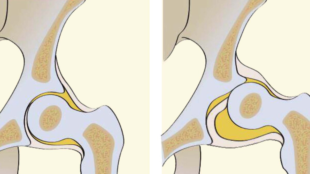 Дисплазия тазобедренных суставов анатомия