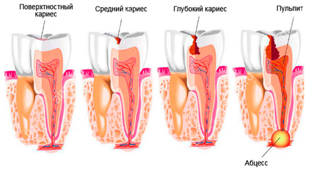 Почему зубы реагируют на холодное или сладкое?