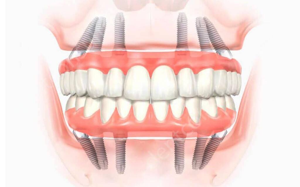 All-on-6 Фото с сервиса Яндекс.картинки