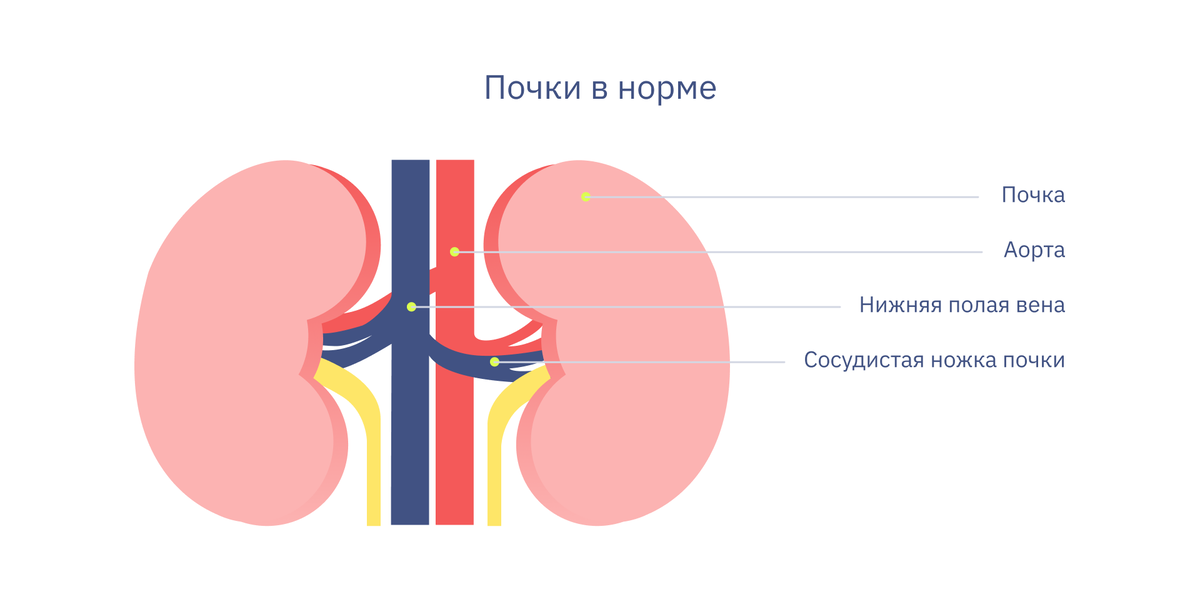 Лечение нефроптоза - Клиники Беларуси