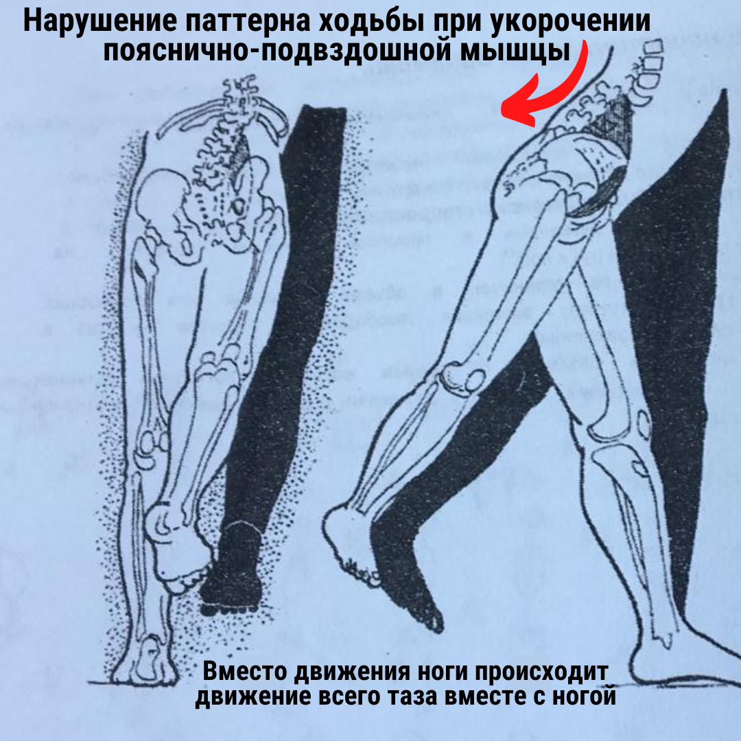 Асимметрия при ходьбе. Передний наклон таза. Передний наклон таза мышцы. Упражнения для правильного положения таза. Передний наклон таза упражнения