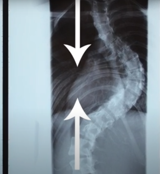 Сдавливание полости лёгких