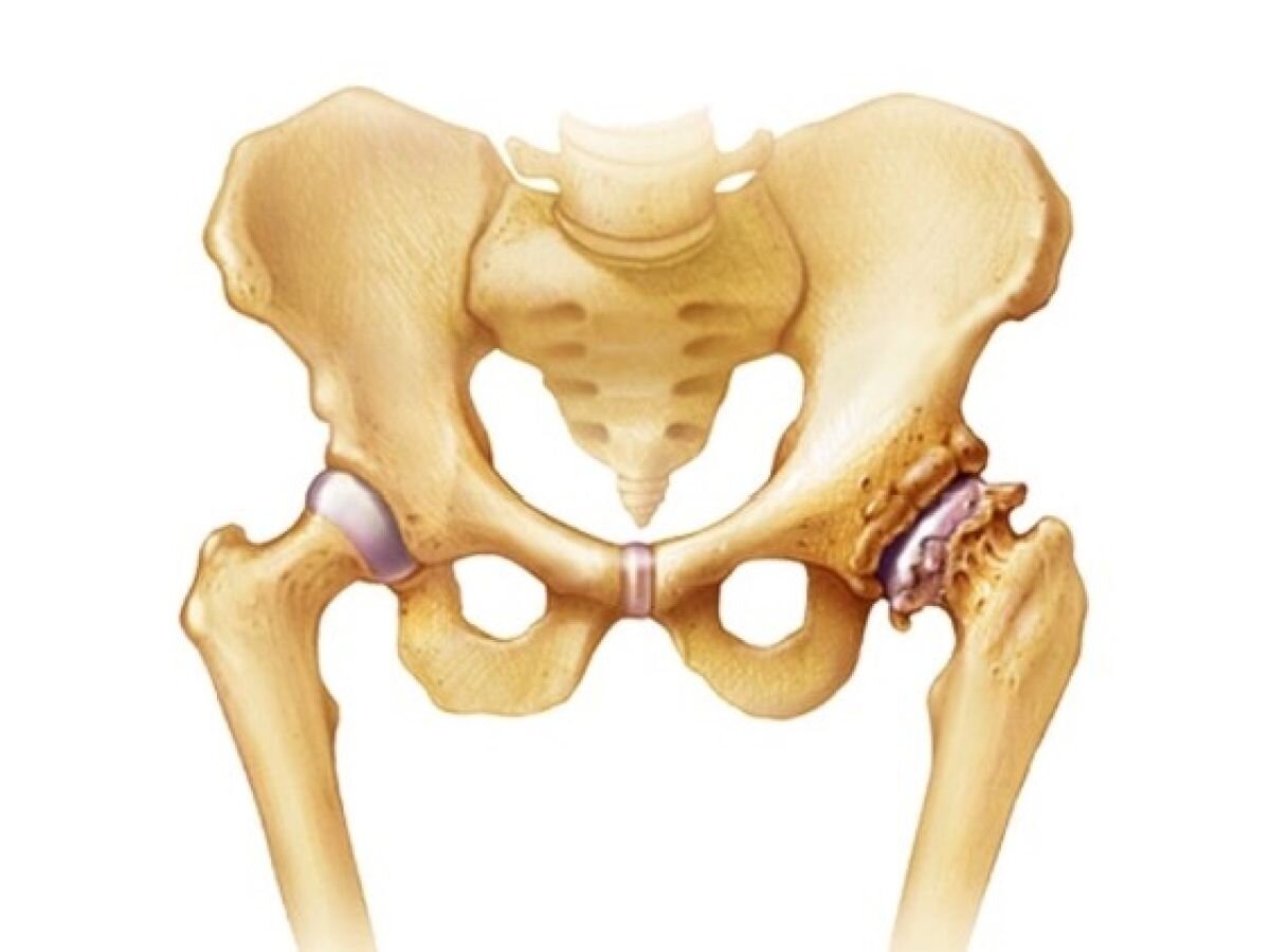 Тазобедренный артрит лечение. Коксартроз тазобедренного сустава. Коксалгия тазобедренного сустава. Кокриортоз тазабедрынов суставов. Остеоартроз тазобедренного сустава.