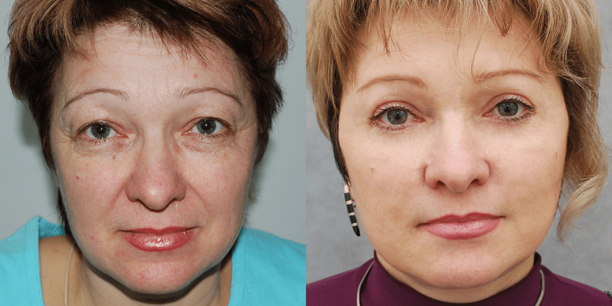 Фото до и после подтяжки лица. Фото с сайта Д.Р. Гришкяна. Имеются противопоказания, требуется консультация специалиста