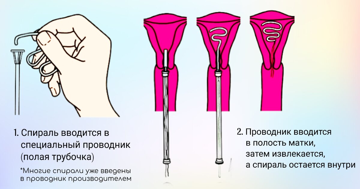 Введение и удаление ВМС под контролем УЗИ