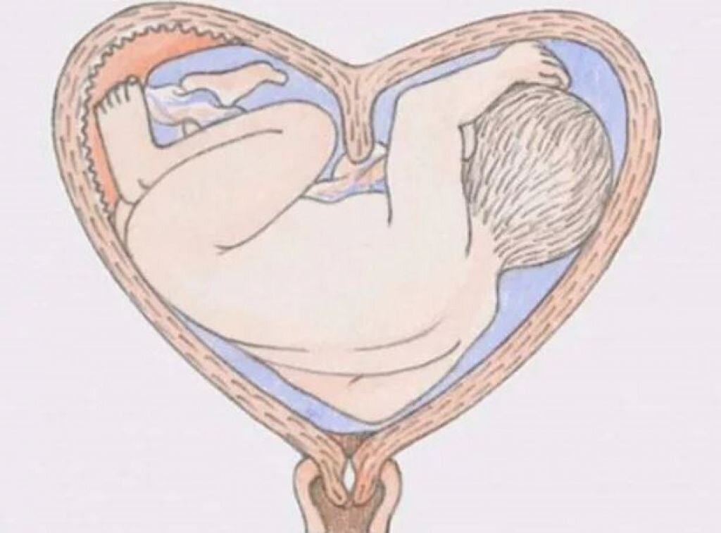 Двурогая матка форум. Двурогая седловидная матка. Сердцевидная двурогая матка. Седловидная или двурогая матка. Двурогая матка и беременность.