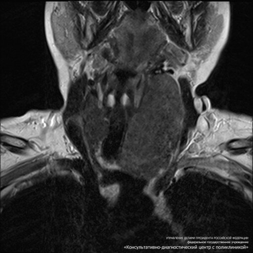 Где сделать мрт мягких тканей. Диффузно-Узловой зоб мрт. Кт и мрт щитовидной железы.