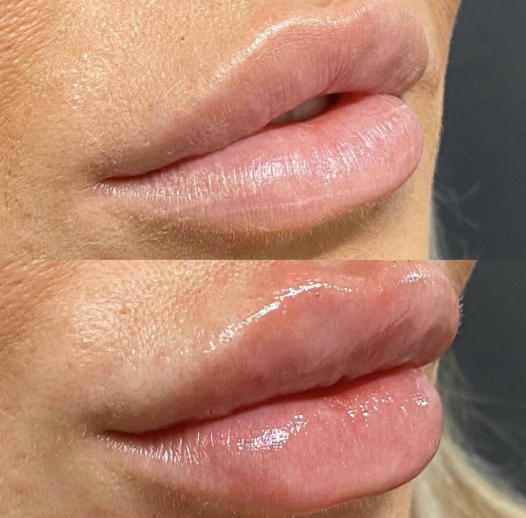 Увеличение губ lips. Накаченные губы красивые формы.