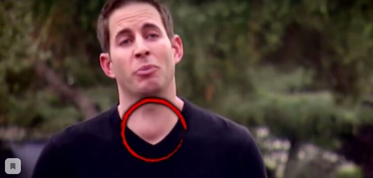 Кадр из шоу, на котором, телезрительница рассмотрела у него опухоль.