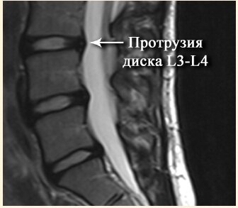 Протрузия межпозвоночного диска L3-L4