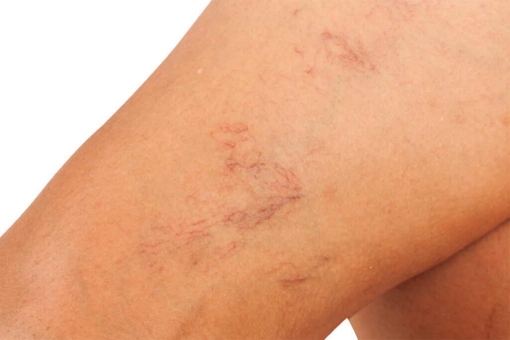 Разрыв сосудов на ногах – причины 