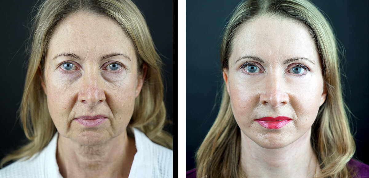 Результат круговой подтяжки лица и верхней блефорапластики спустя 2 месяца после операции.