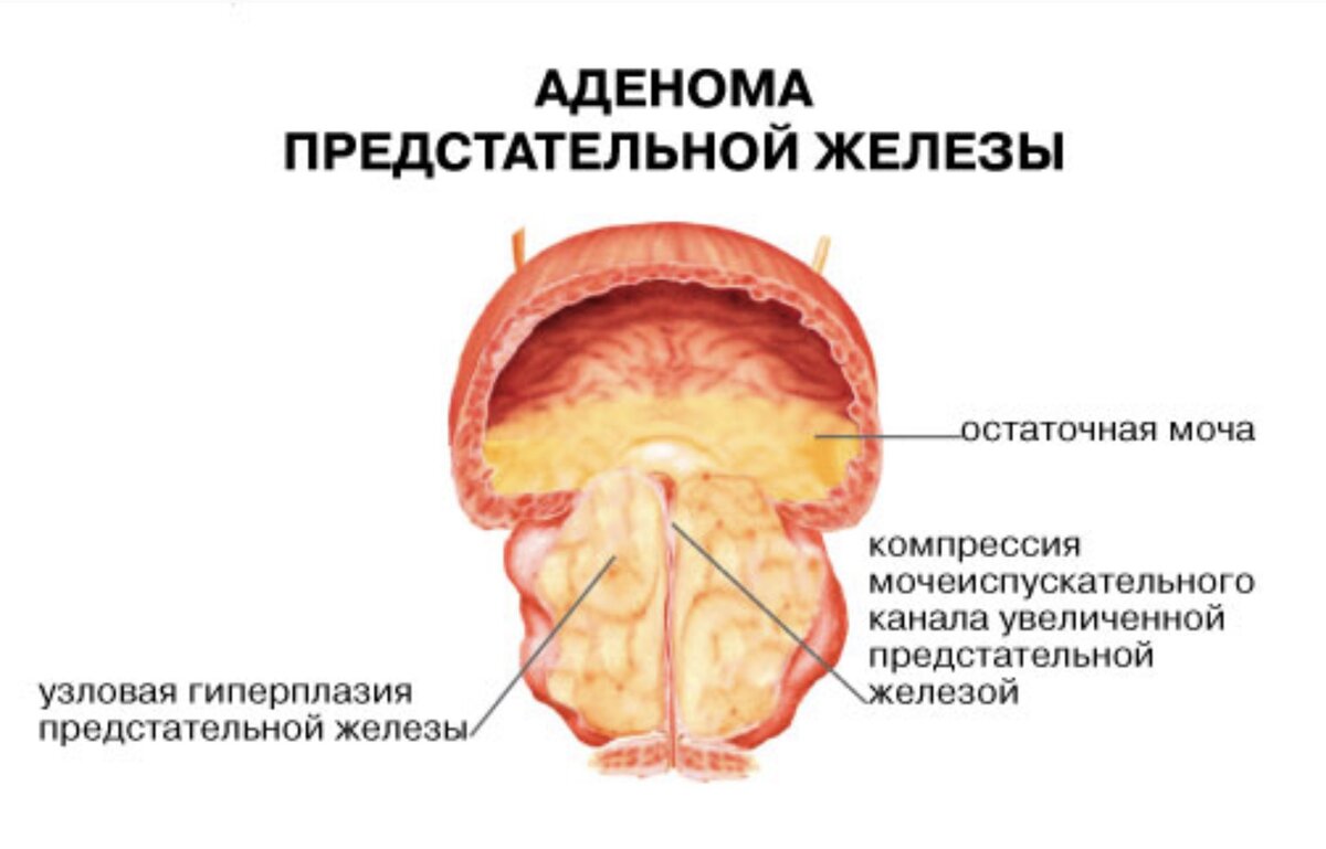 Аденома простаты