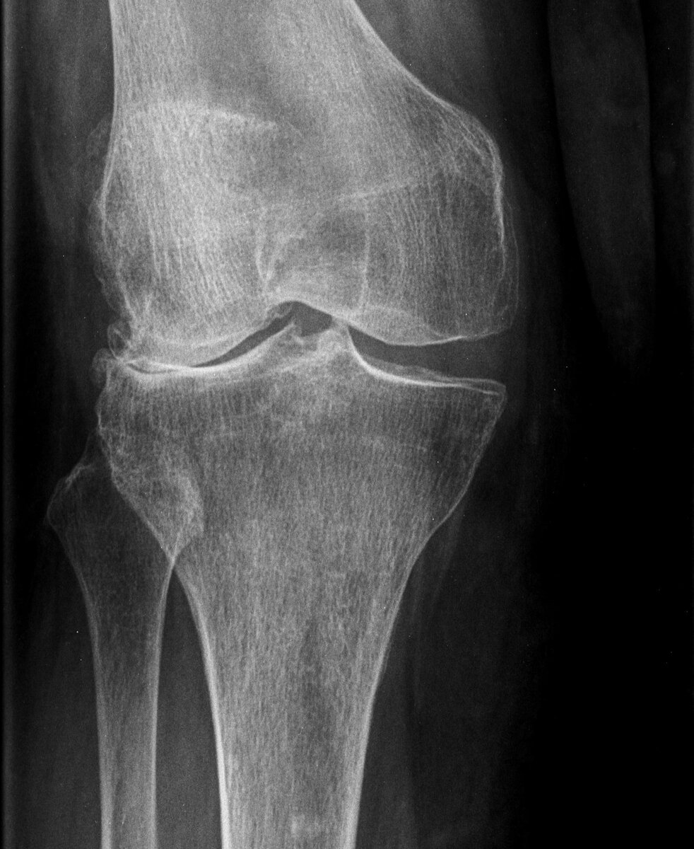 Рентген снимок гонартроза. Сустав просел и кость трётся об кость.