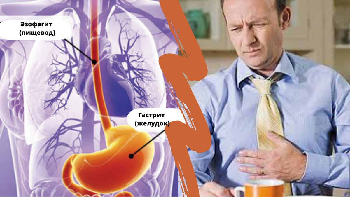 Как отличить изжогу от сердечного приступа