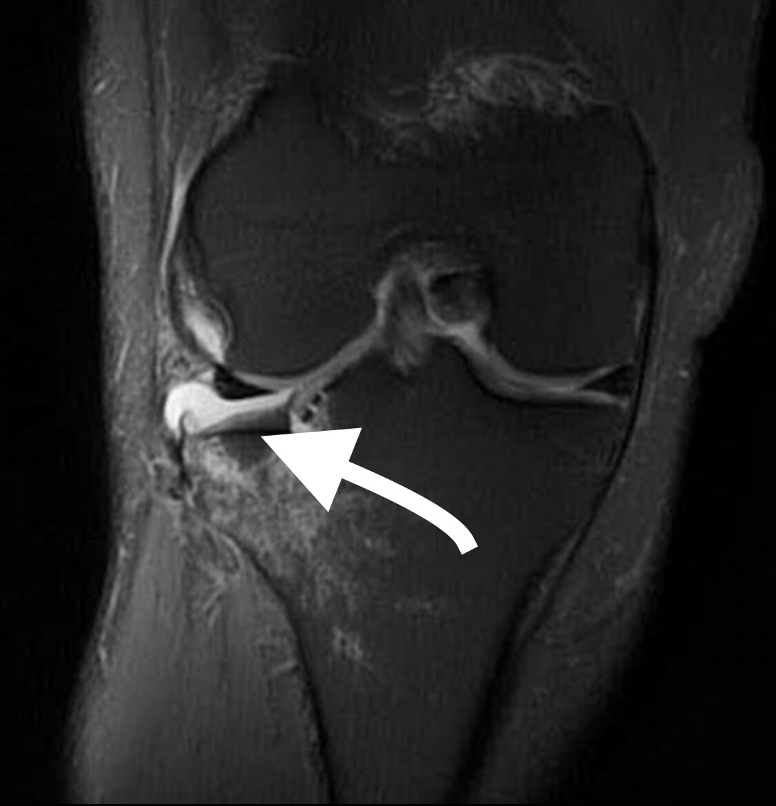 Пример с сайта Radiopaedia Floating meniscus Last revised by Utkarsh Kabra on 16 Dec 2019 . Cor Pd_tse_fs