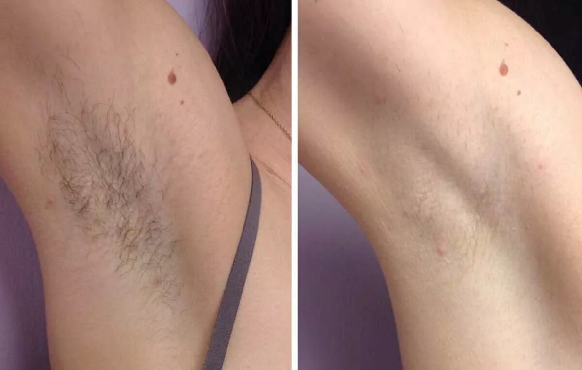 За 2 минуты удалила все волосы с подмышек.