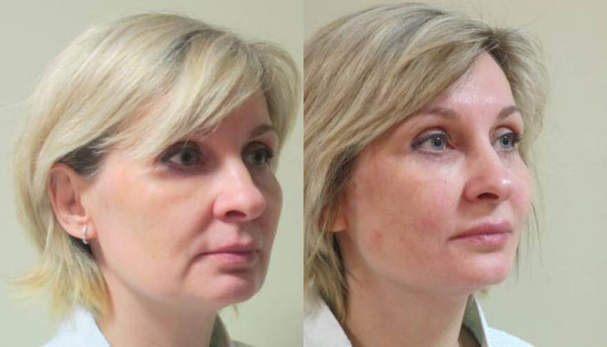 Мезонити отзывы фото до и после
