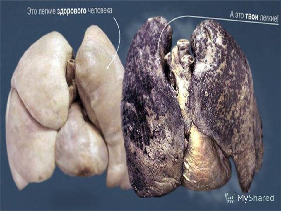 Боль в груди после курения: причины