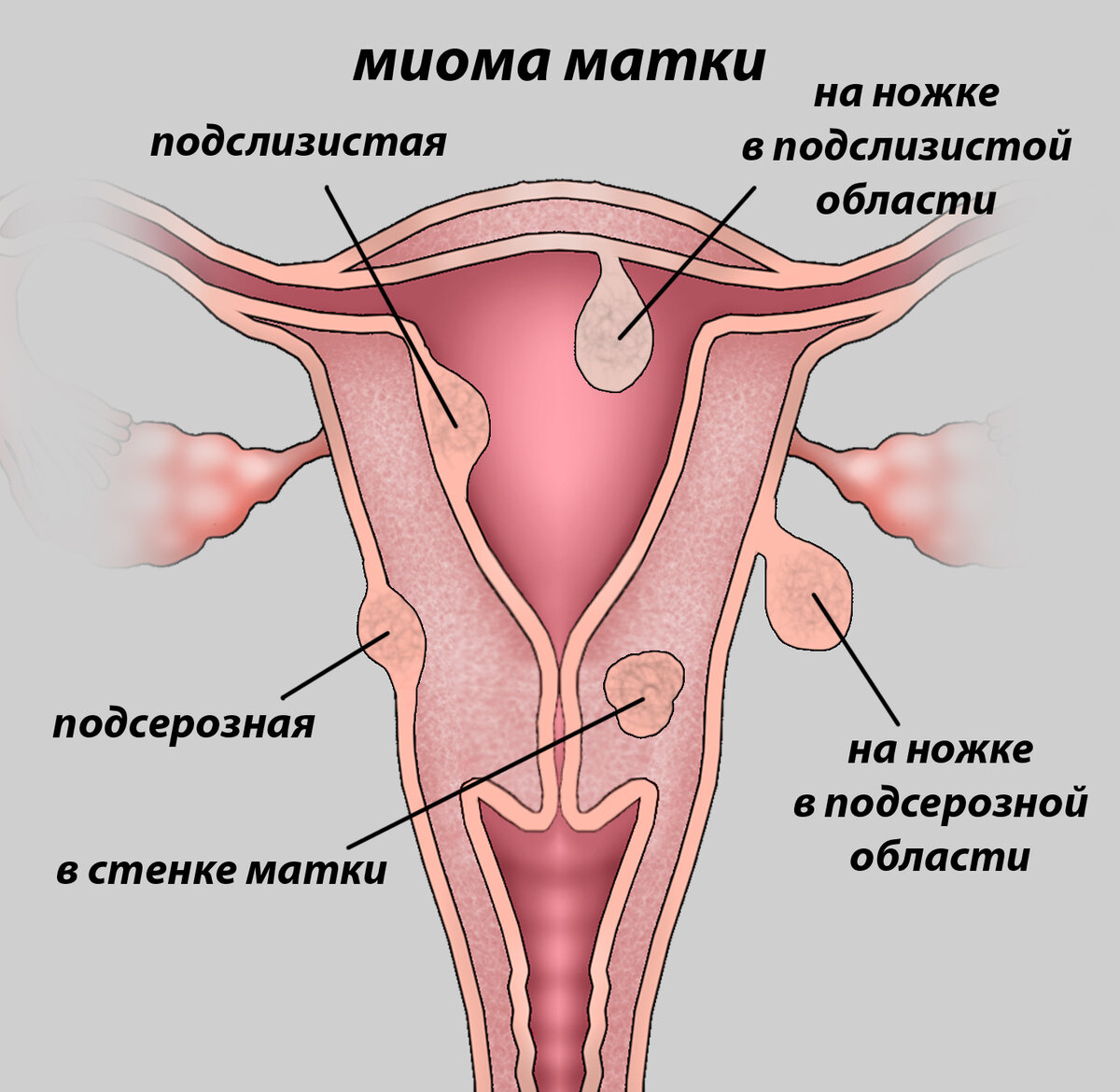 Миома матки: 5 вещей, которые нужно знать | саквояж знаний | Дзен