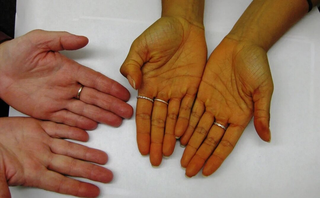 Справа - руки пациента с желтухой. Фото из открытых источников. 