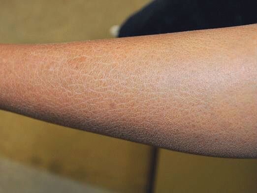 Зимой кожа сохнет от отопительных приборов дома.