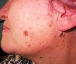 Пример возрастных бородавок на лице