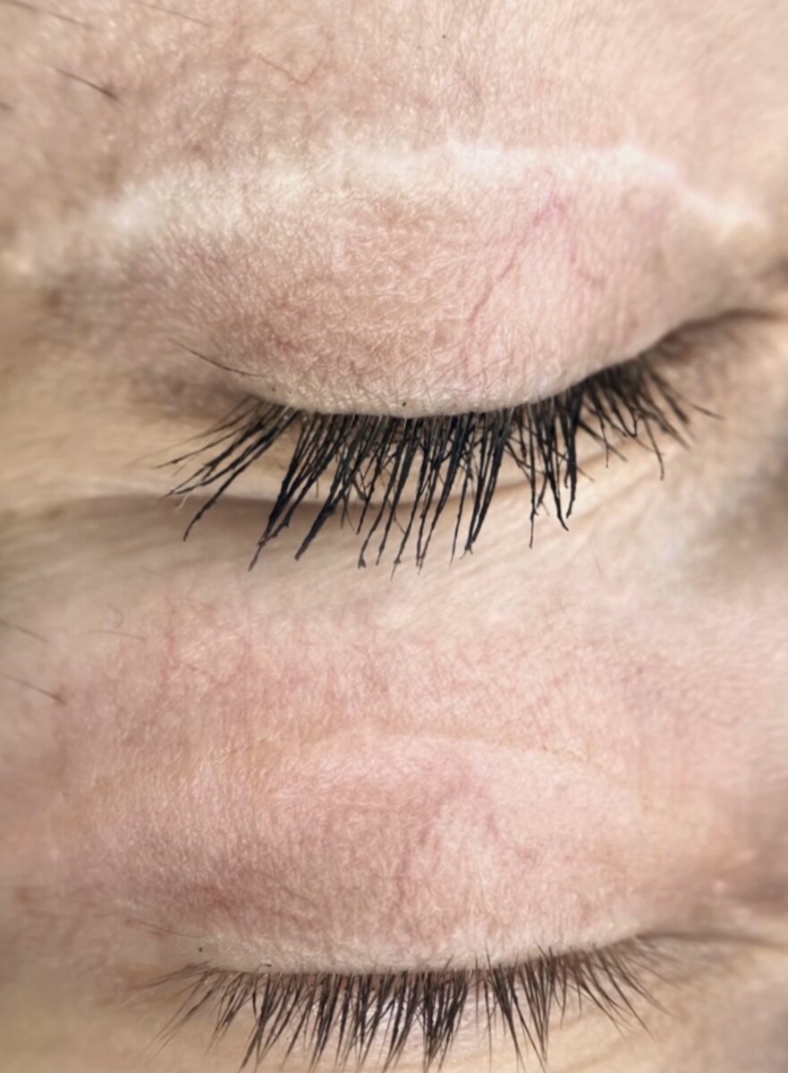 Результат одной процедуры перекрытия шрама от блефаропластики 