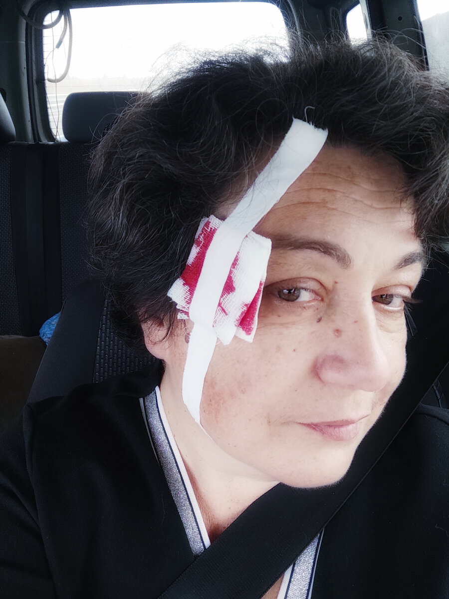 Самое "кровавое", но самое лëгкое в лечении было кормление пиявок на виске - врачи снимали внутренний отëк всеми доступными средствами. 