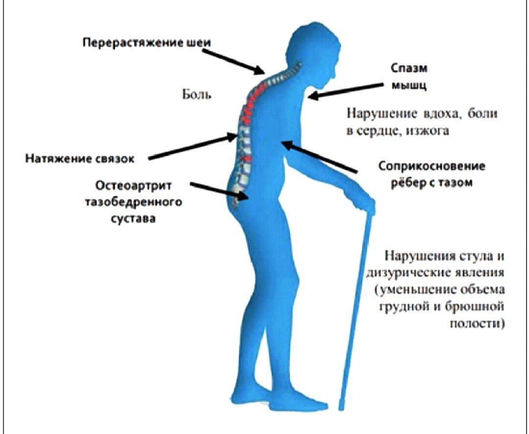 Клинические проявления множественных компрессионных деформаций тел позвонков. 