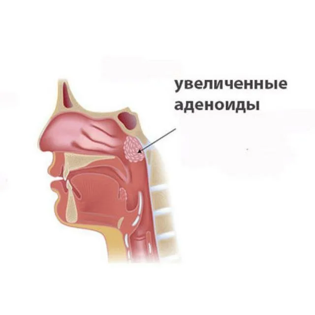 Где находятся аденоиды у ребенка картинка