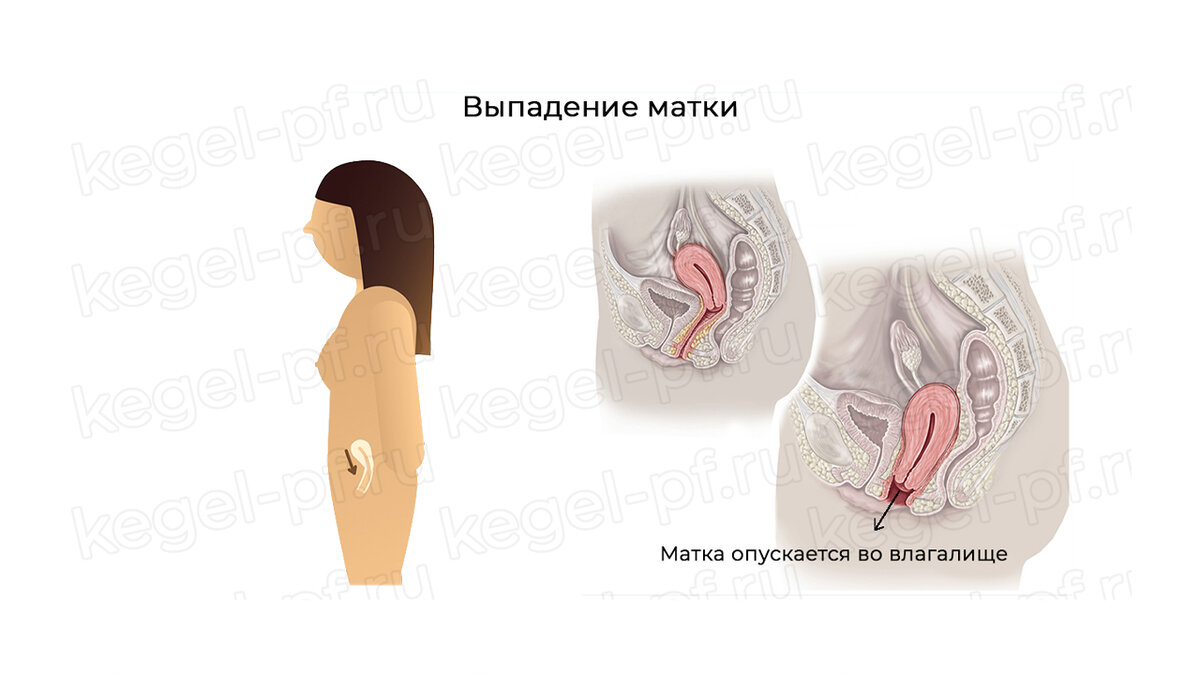 Выпадение матки после родов