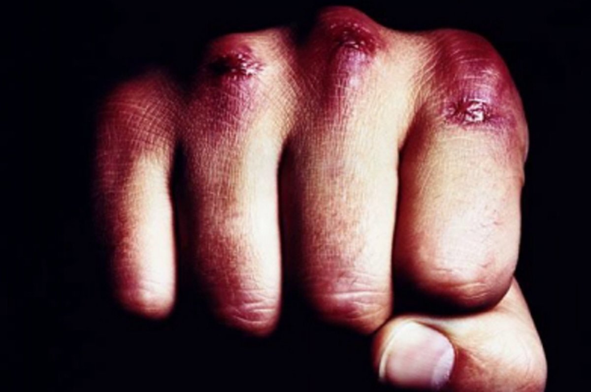    Сойдет с рук? На Дону бывший ухажер сломал челюсть 14-летней девочке