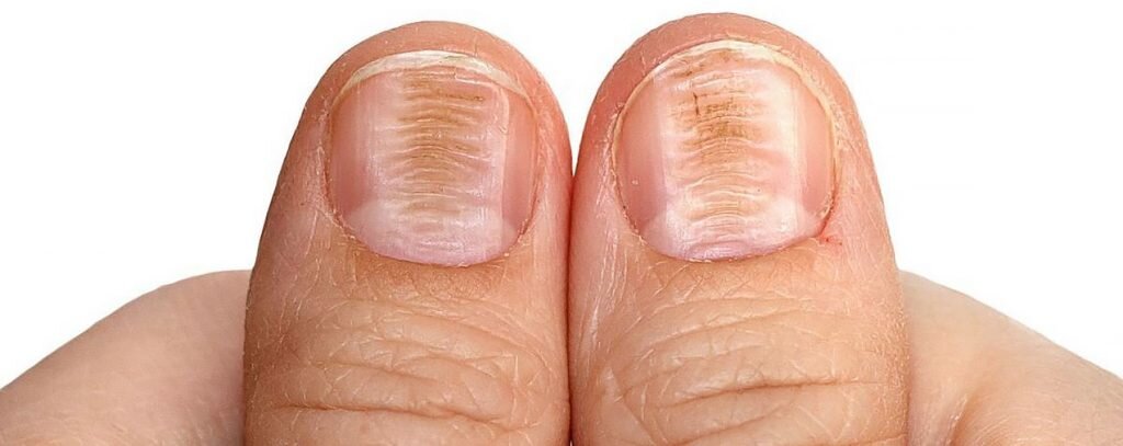 Возможные заболевания, которые можно определить по ногтям