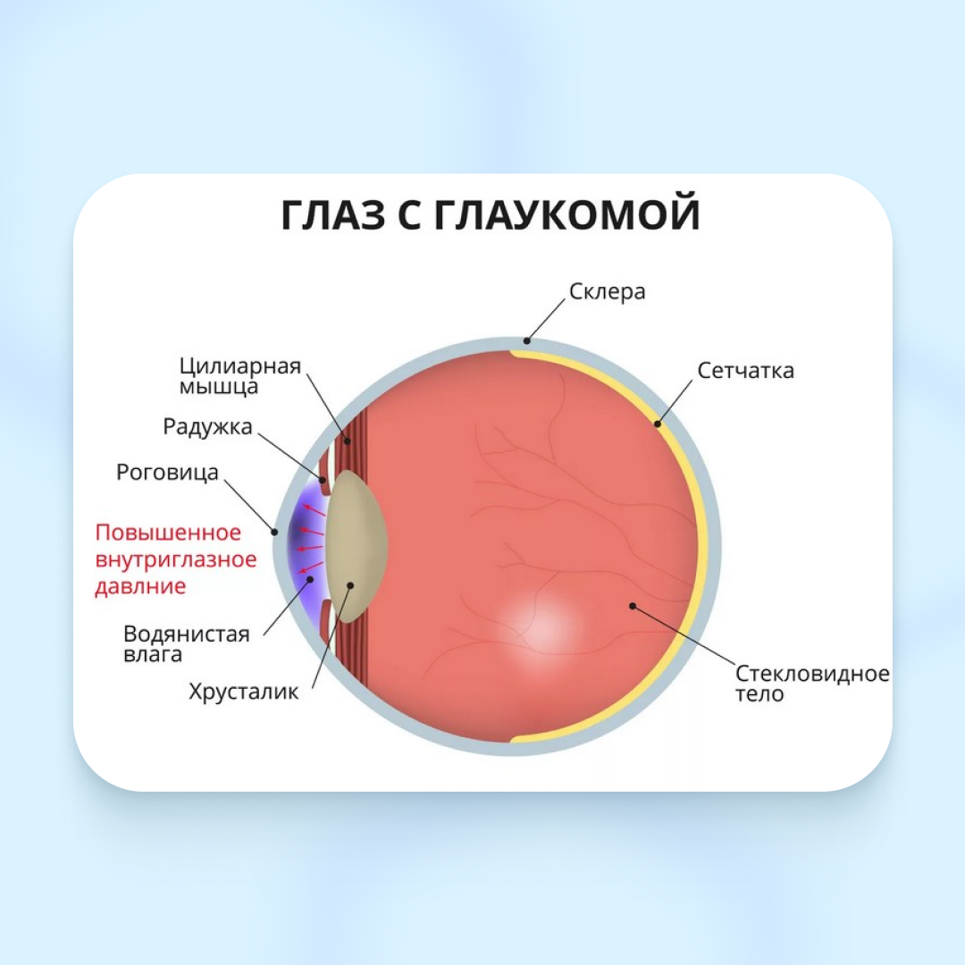 Может ли глаукома передаваться по наследству? | Статьи от клиники Сокол