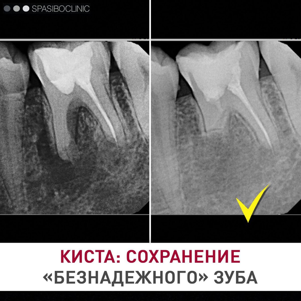 киста зуба мудрости фото