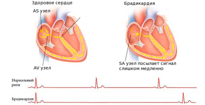 Брадикардия что это такое. Брадикардия. Брадикардия сердца что это. Давление при брадикардии. Патологическая брадикардия.