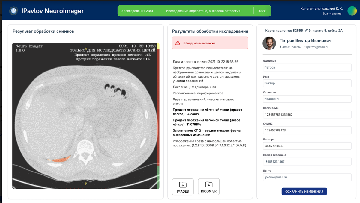 iPavlov CDSS Neuro-Imager распознает патологические образования по цифровым снимкам КТ/НДКТ ОГК, МРТ, ММГ, РГ/ФЛГ и подает сигнал тревоги врачу в случае превышения заранее заданных критических значений