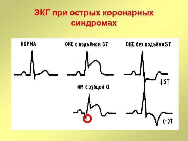 Карта вызова c окс c подъемом сегмента st