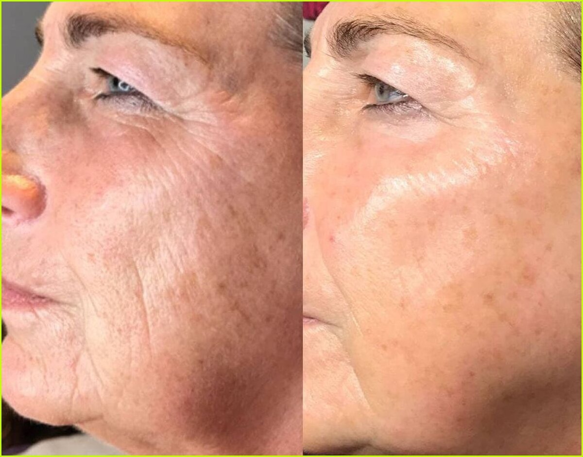 Лифтинг от плазмолифтинга. Лицо сразу после плазмолифтинга. Плазмотерапия(лифтинг). Плазмолифтинг для лица. Плазмолифтинг для лица.