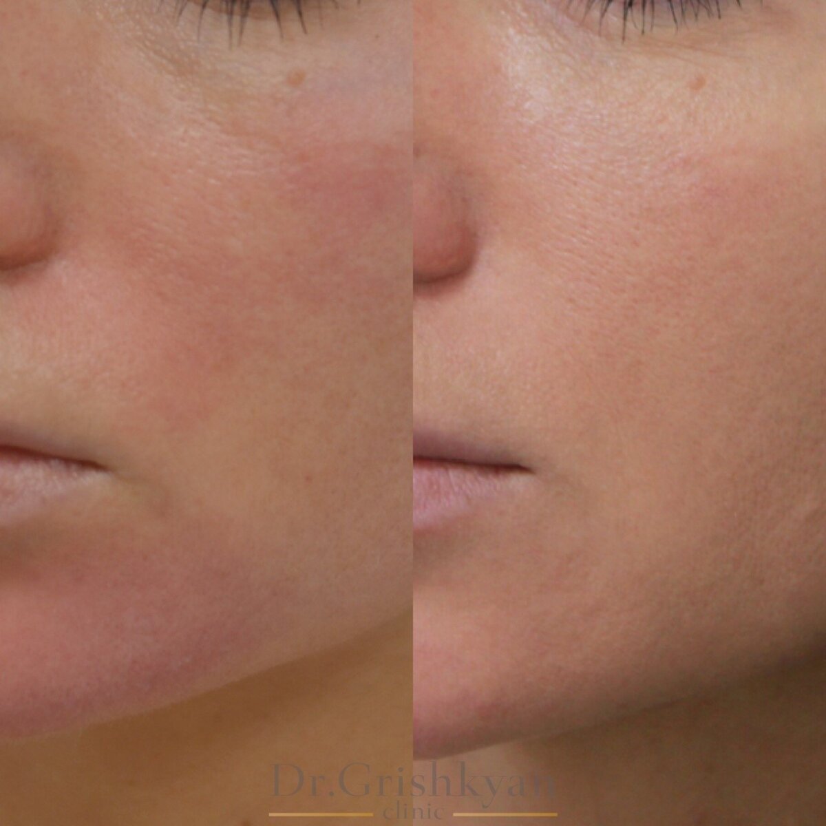 Кожа после пилинга. Специалист Морозова Анастасия Вячеславовна.