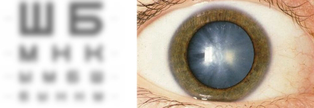 Глазное зрение 1. Спицевидная катаракта. Кольцевидная катаракта Фоссиуса. Сенильная катаракта глаза.