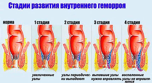 Наружный геморрой