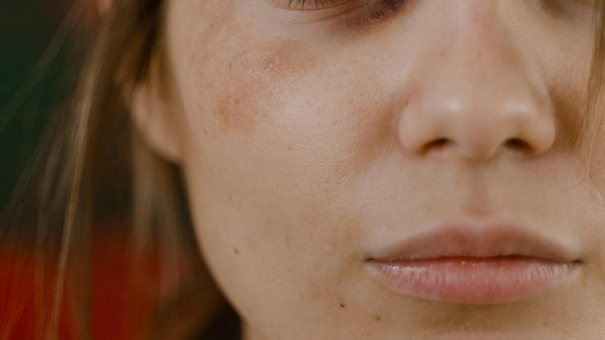   Девушка с синяками на лице:pexels.com
