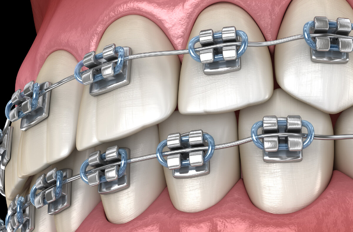 Брекеты стоимость