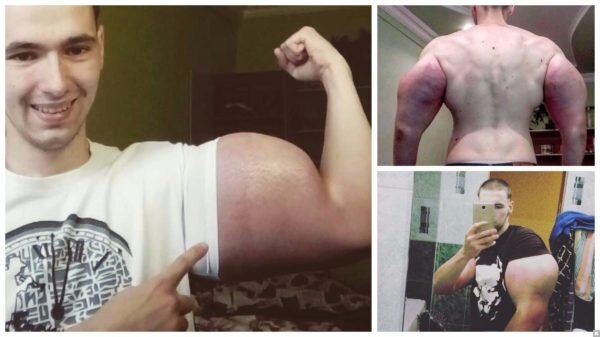 Ради собственной славы он рискует здоровьем – синтол давно считается запрещенным препаратом, да и нормы инъекций просто зашкаливают.