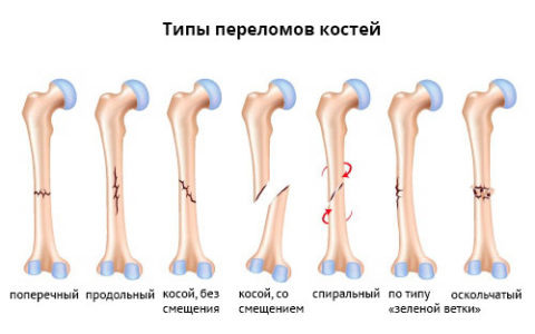  На фото типы повреждений кости.