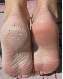 Лечение сухости кожи ног